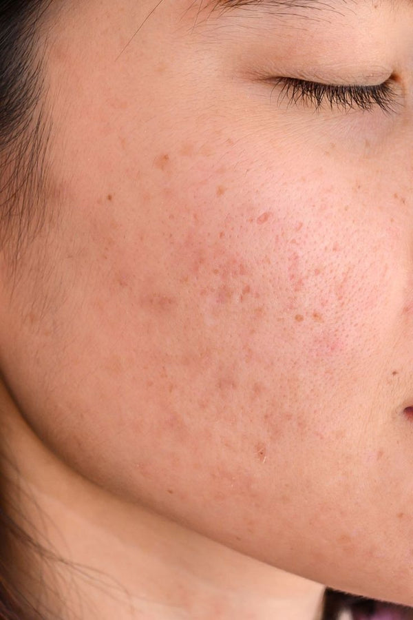 Targets the Look of Dark Spots